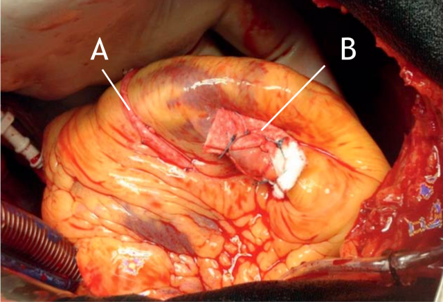Figura 2. A. Injerto de Vena Safena a la arteria descendente anterior B. Reparo del Aneurisma Ventricular izquierdo