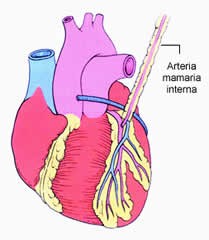 Figura 1. Cirugía coronaria con dos arterias