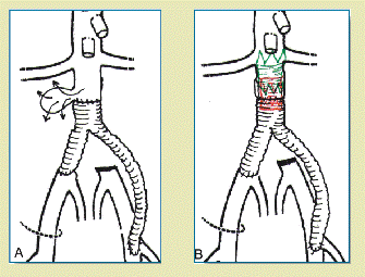 Figura 2. Reparo endovascular de aneurisma