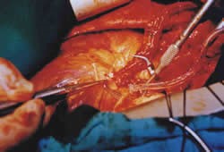 Figura 3. Cirugía coronaria con dos arterias