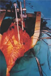 Figura 4. Cirugía coronaria con dos arterias