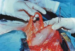 Figura 5. Cirugía coronaria con dos arterias