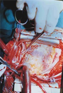 Figura 6. Cirugía coronaria con dos arterias