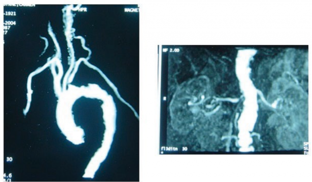 Figura 1. Angioresonancia de una paciente con “Shaggy Aorta”.