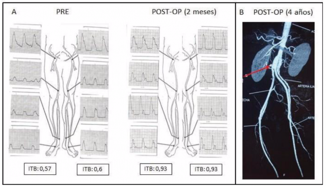 Figura 2. A: Pletismografía Doppler arterial pre y postoperatoria (2 meses) en un paciente con EAOI – TASC B 