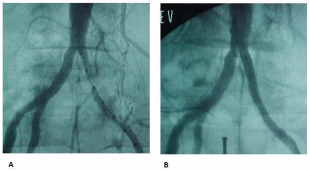 Figura 4. A: Angiografía pre procedimiento en un paciente con EOAI-TASC A. B: Angiografía post procedimiento